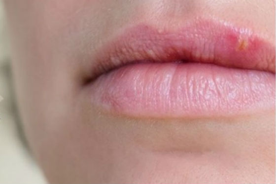 herpes labial labios significado